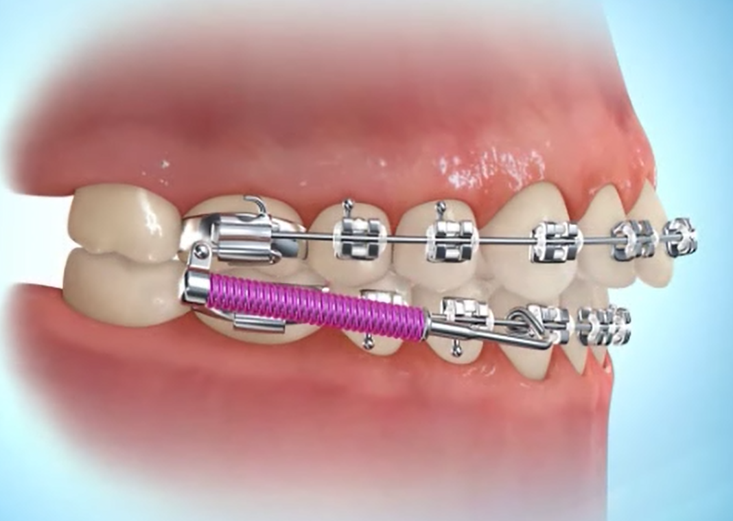 Forsus veren Ortho Uithoorn
